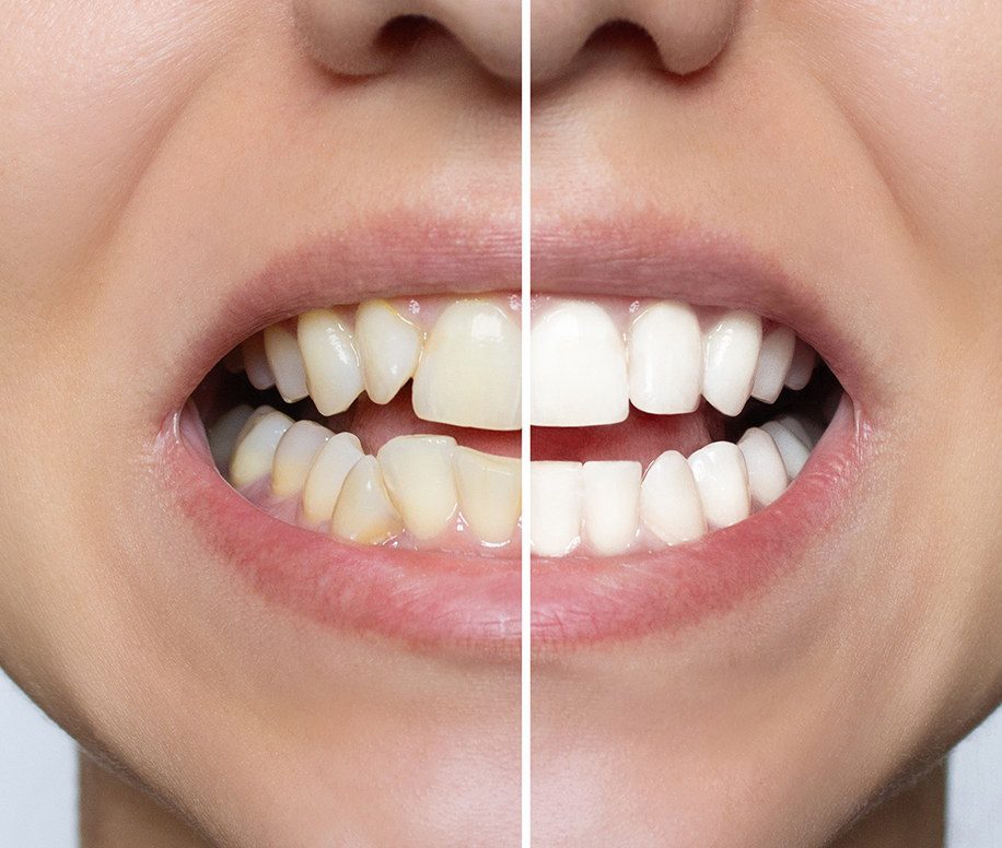 Ce que vous devez savoir sur la couleur des dents Ce que vous devez savoir sur la couleur des dents