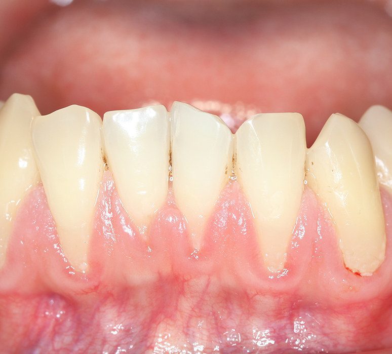 Ce qu’est la récession gingivale Ce qu’est la récession gingivale
