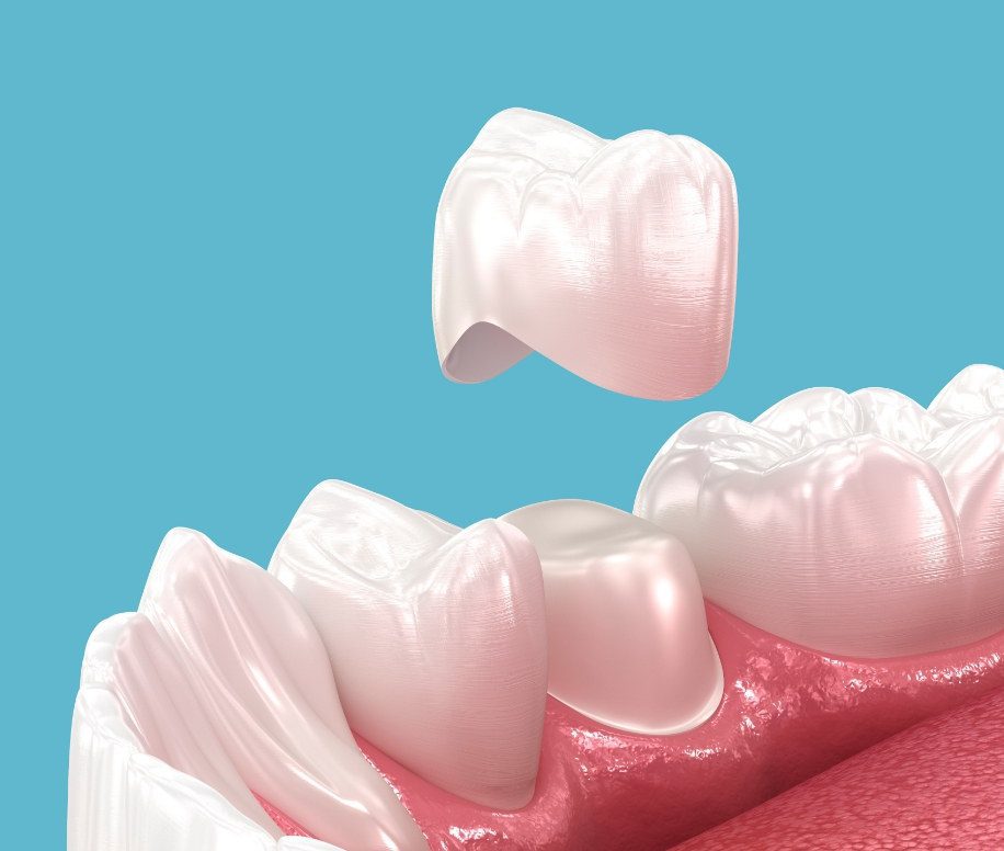 Dans quelles situations le CEREC est-il recommandé Dans quelles situations le CEREC est-il recommandé