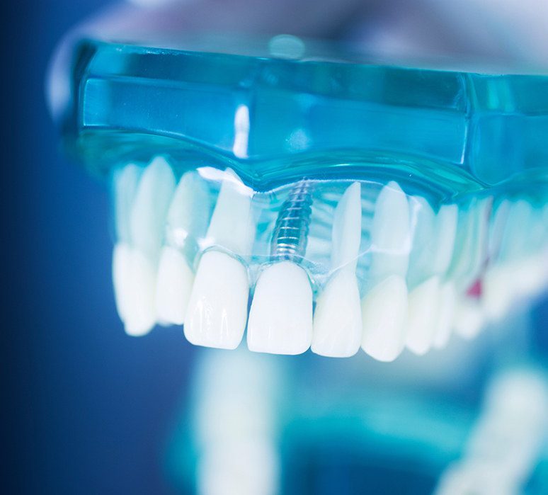Pourquoi les implants dentaires sont-ils une bonne option de substitution ? Pourquoi les implants dentaires sont-ils une bonne option de substitution ?