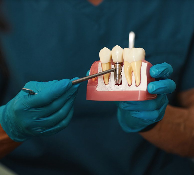 Qu’est-ce qu’un implant dentaire ? Qu’est-ce qu’un implant dentaire ?